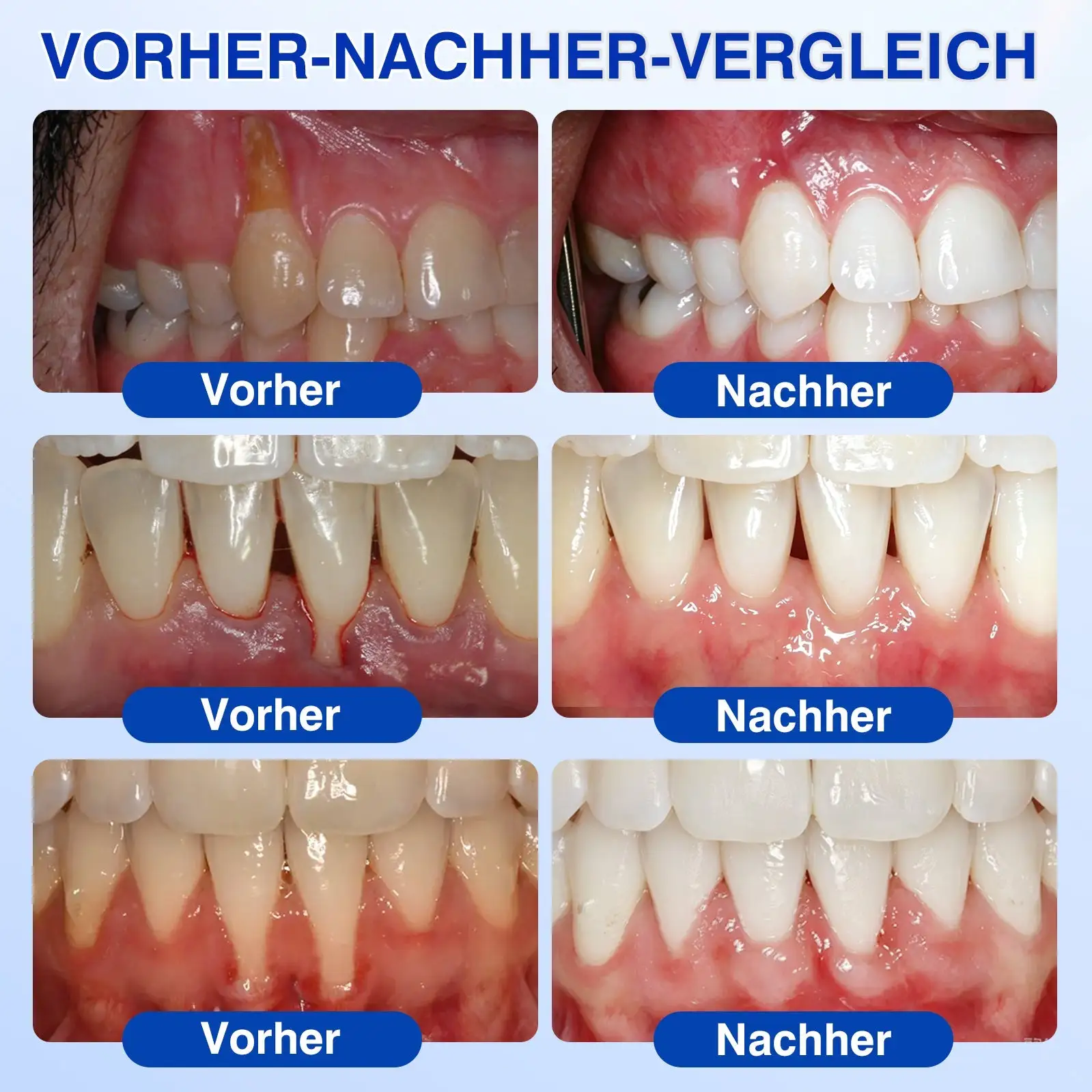 𝐋𝐮𝐱𝐚𝐫𝐢𝐬𝐞® GumRevive Parodontal-Reparaturgel