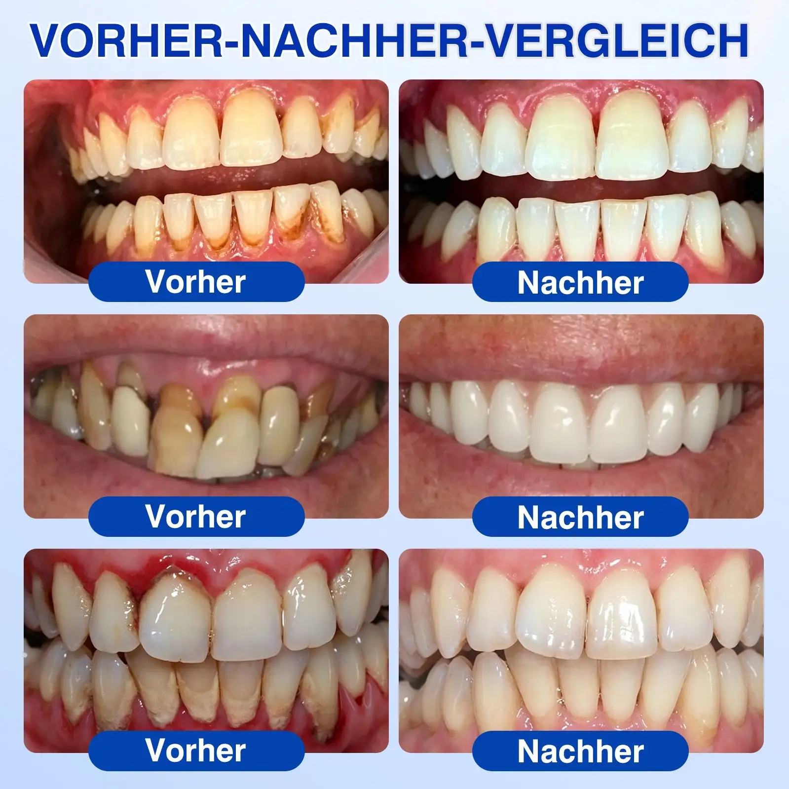 𝐋𝐮𝐱𝐚𝐫𝐢𝐬𝐞® GumRevive Parodontal-Reparaturgel